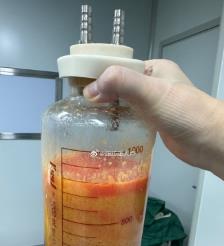 广东水动力吸脂手术要做多久？